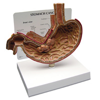 Anatomical Stomach Cancer Model