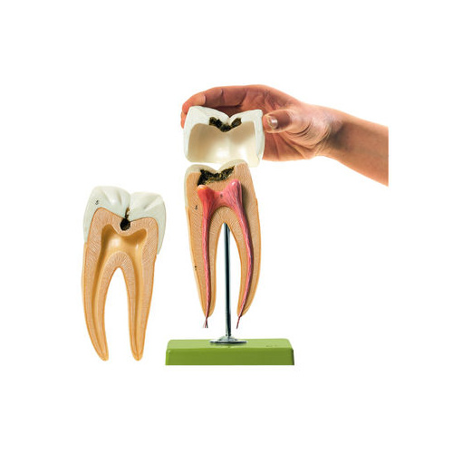 Molar Tooth with Caries