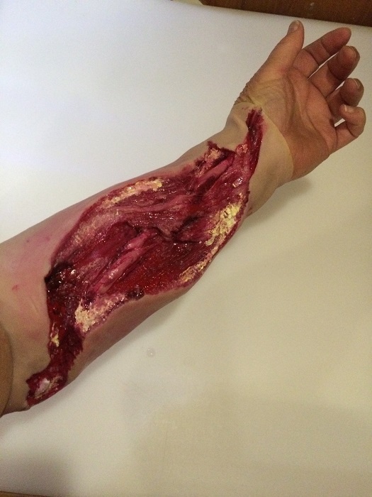MB130 Silicon Electrical Burn Lower Arm