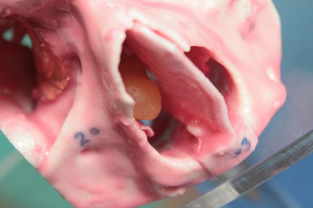 PHACON Sinus Patient “Meyer” – with polyps (SN-ae)