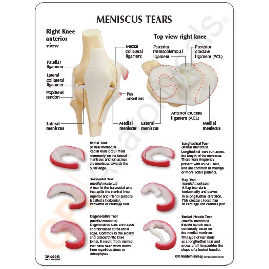Anatomical Meniscus Tears of the Knee Model