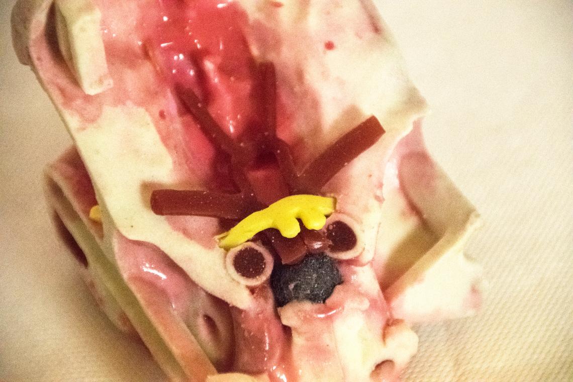 PHACON Sinus Patient “Meyer” – subcranial extension (SN-am)