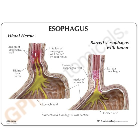 Anatomical Model- Gastroesophageal Reflux Disease (GERD)
