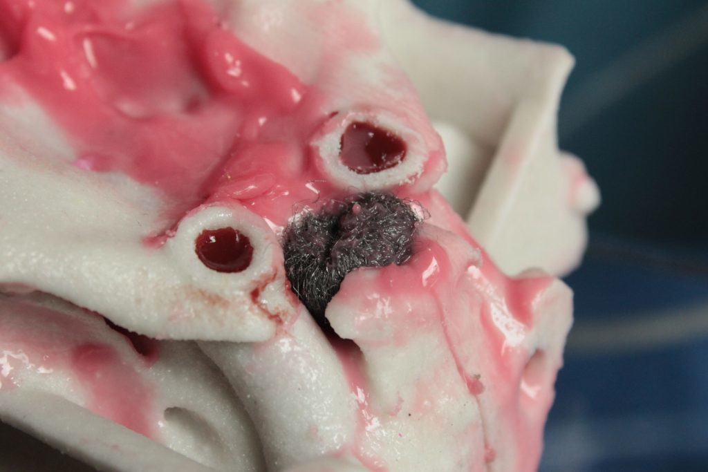 PHACON Sinus Patient “Meyer” – with polyps (SN-ae)