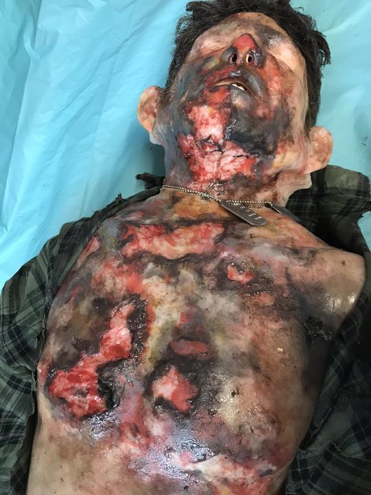 MB810 Burn Victim Face Overlay