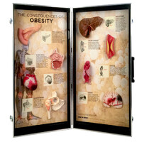 The Consequences of Obesity 3-D Display