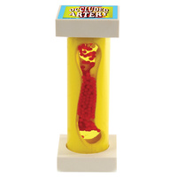 Occluded Artery Model