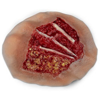Wound - Burn, 4th Degree, Dorsal Hand