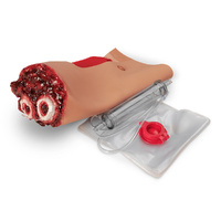 Wound - Arm Amputation