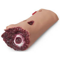 Wound - Leg Amputation