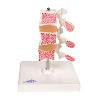 Anatomical Model -  Osteoporosis Model (3 Vertebrae)