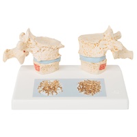 Anatomical Model- Osteoporosis Model