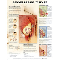 Anatomical Benign Breast Disease Chart