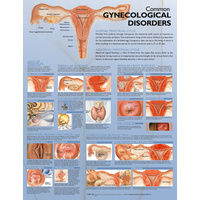 Common Gynecological Disorders (Poster - Rigid Lamination)
