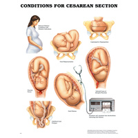 Conditions for Cesarean Section (Poster - Soft Lamination)