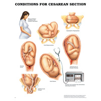 Anatomical Chart- Conditions for Cesarean Section