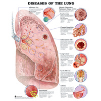 Diseases of the Lung (Poster - Soft Lamination)