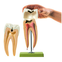 Molar Tooth with Caries