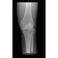 X-Ray Phantom Knee, -Opaque