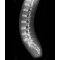 X-ray Phantom Spine, Opaque