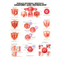 Anatomical Chart- Female External Genitalia Anatomy & Pathology 