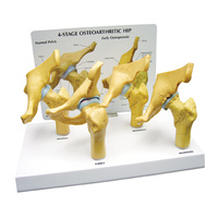 Anatomical 4 Stage Arthritic Hip Model