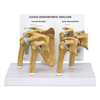 Anatomical 4 Stage Osteoarthritis Shoulder Model
