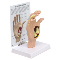 Anatomical Osteoarthritis Hand Model