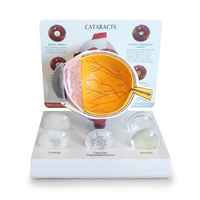 Anatomical Model- Cataract Eye