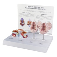 COPD (Bronchus/Aveoli)