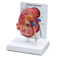 Kidney Cancer