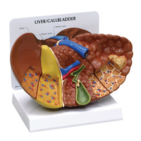 Anatomical Model- Diseased Liver