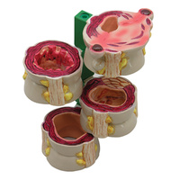 Anatomical Model- 4 Piece Colon with Pathologies