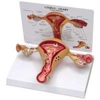 Anatomical Model - Uterus-Ovary Cancer