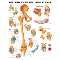 Hip & Knee Inflammations (Poster - Rigid Lamination)