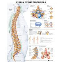 The Human Spine - Disorders (Poster - Rigid Lamination)