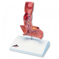 Anatomical Model - Diseases of the Esophagus