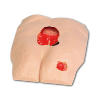 Stan Stage IV Pressure Ulcer Model