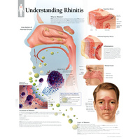 Understanding Rhinitis