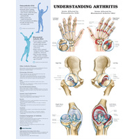 Anatomical Chart- Understanding Arthritis