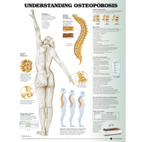 Anatomical Chart- Understanding Osteoporosis Chart