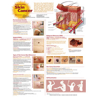 Understanding Skin Cancer (Poster - Soft Lamination)