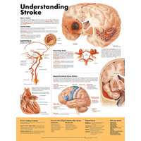 Understanding Stroke (Poster - Soft Lamination)