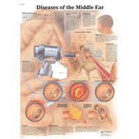 Anatomical Models about Diseases of the Middle Ear