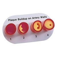 Artery Section with Blockage