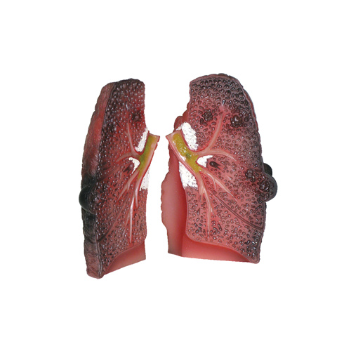 Cough Up a Lung Model