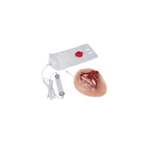 Wound - Open Rib Fracture