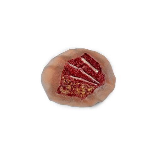 Wound - Burn, 4th Degree, Dorsal Hand