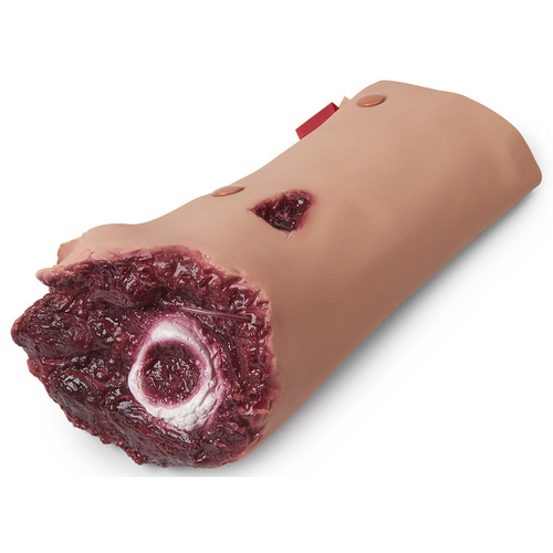 Wound - Leg Amputation