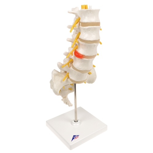 Anatomical Lumbar Spinal Column with Prolapsed Intervertebral Disc Model